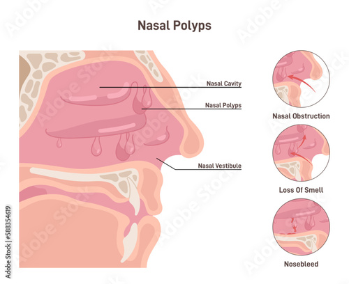 Nasal polyps. Noncancerous growths on the lining of the nose or sinuses.