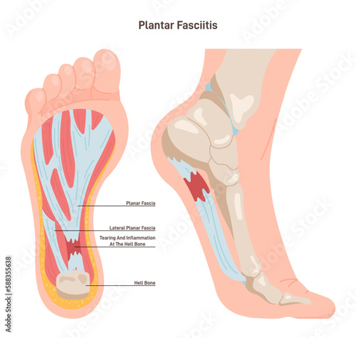Plantar fasciitis. Plantar fascia inflammation or tearing. Disorder