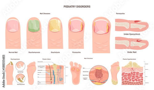 Podiatry diseases set. Feet and nails disorders or medical condition