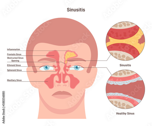Sinusitis. Inflamed sinus with excess mucus and obstructed airways
