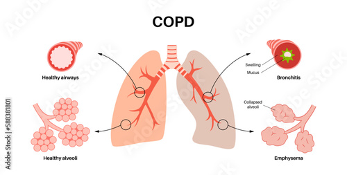Chronic obstructive pulmonary disease