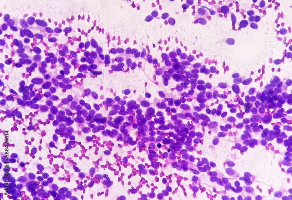 USG guided FNA cytology of liver SOL showing Non Hodgkin lymphoma. Metastatic carcinoma.