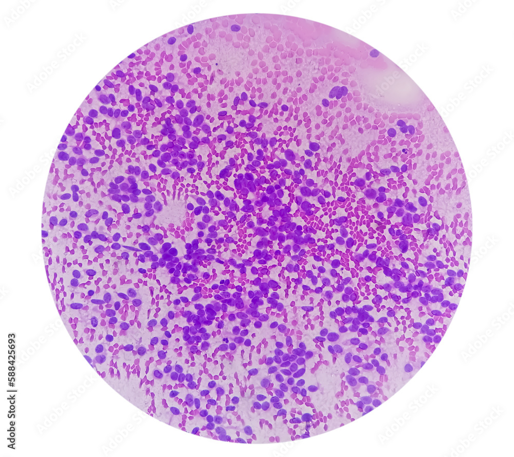 USG guided FNA cytology of liver SOL showing Non Hodgkin lymphoma. Metastatic carcinoma. USG guided FNA cytology of liver SOL showing Non Hodgkin lymphoma. Metastatic carcinoma.