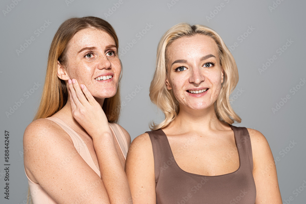 Overjoyed women with skin issues posing isolated on grey. Overjoyed women with skin issues posing isolated on grey.