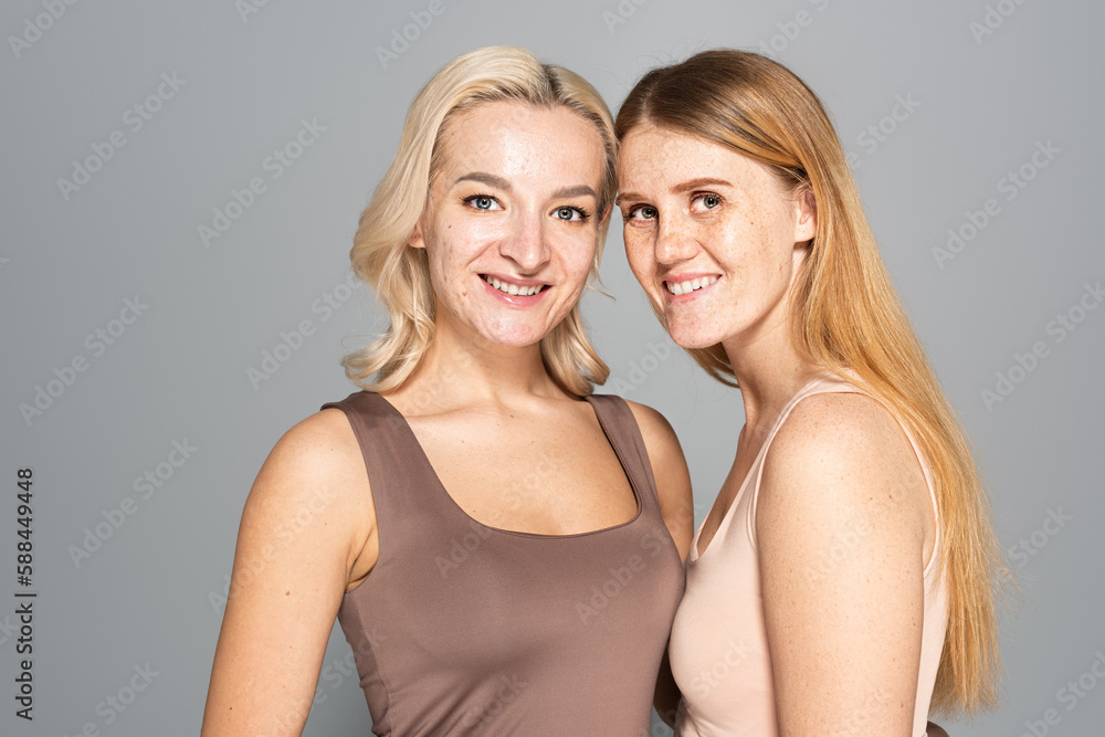 Overjoyed friends with problem skin standing isolated on grey. Overjoyed friends with problem skin standing isolated on grey.
