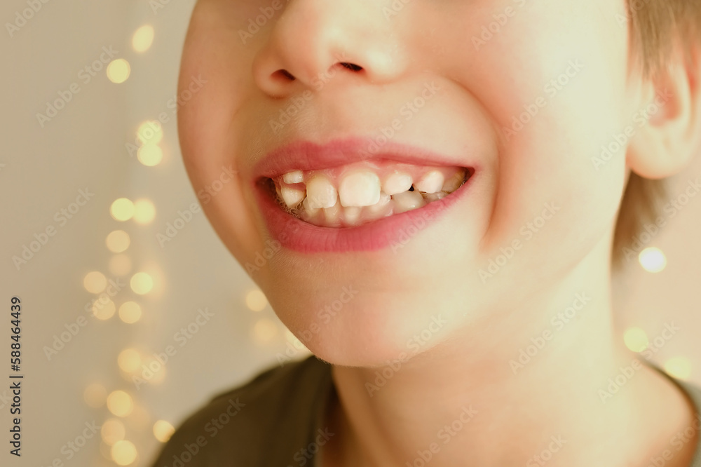 closeup crooked teeth, boy 9-10 years opened mouth, child 8 years old shows teeth, visit to dentist for examination oral cavity, control of molars, temporary teeth, concept of caries prevention closeup crooked teeth, boy 9-10 years opened mouth, child 8 years old shows teeth, visit to dentist for examination oral cavity, control of molars, temporary teeth, concept of caries prevention