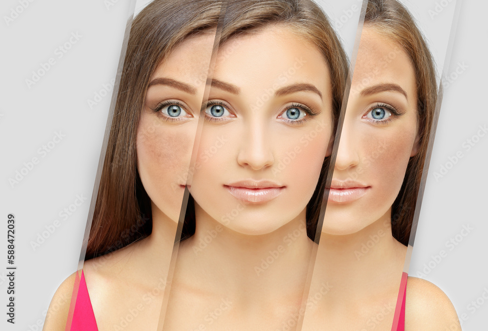 Dark spots, freckles,hyperpigmentation(melasma or chloasma),concept - skin lightening, skin whitening, fruit acids,AHA, Skin Brightening Dark spots, freckles,hyperpigmentation(melasma or chloasma),concept - skin lightening, skin whitening, fruit acids,AHA, Skin Brightening
