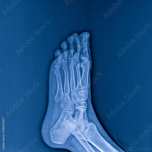 X-ray of foot on dark background, radiograph