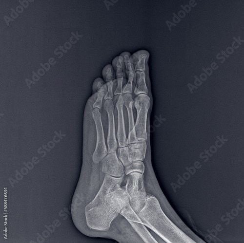 X-ray of foot on dark background, radiograph