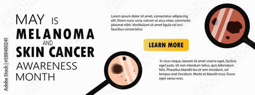 Melanoma and skin cancer awareness month landing page template. Banner template with moles, birthmarks under magnifying glass and copy space for text. Vector illustration