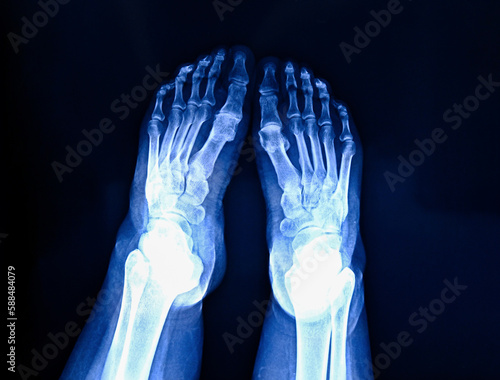 Photos X-ray of foot on dark background, radiograph of feet