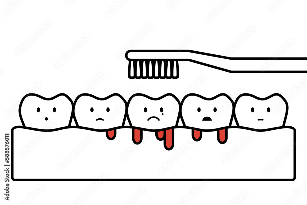 gingivitis or scurvy, brushing teeth with bleeding on gum and tooth
