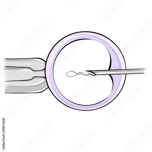 Illustration of intracytoplasmic sperm injection fir in vitro fertilization