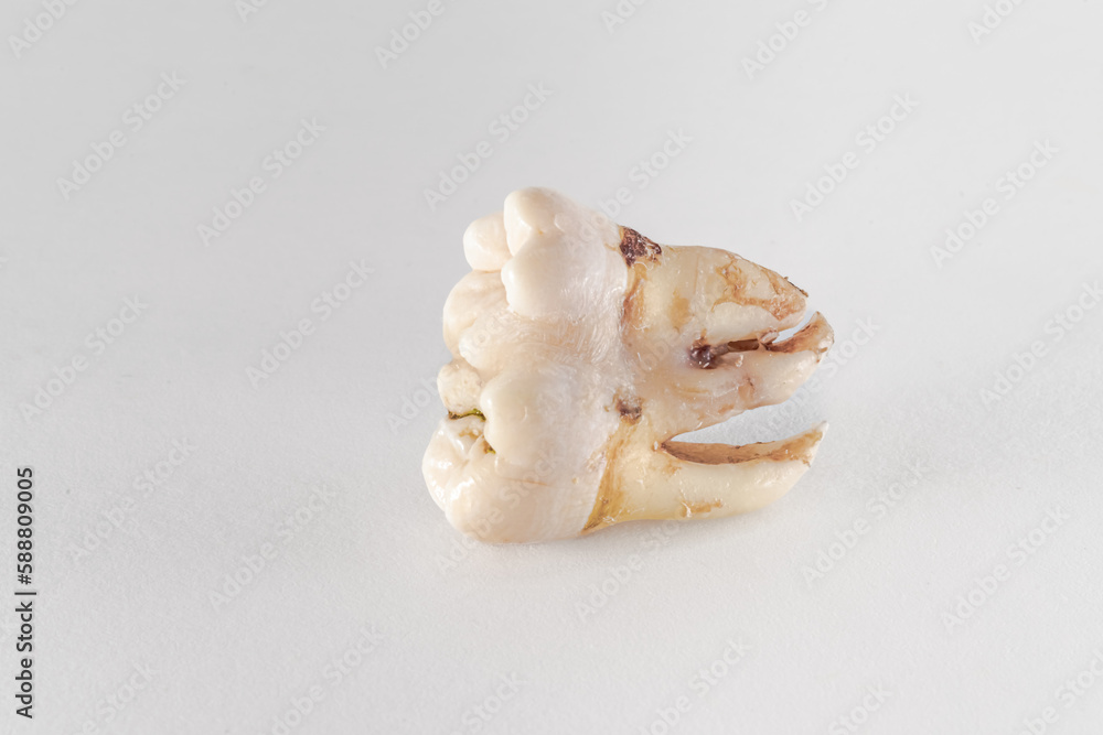 Geminated number 48 lower wisdom tooth posed on a white background. Dental phenomenon that appears to be two teeth developed from one. Geminated number 48 lower wisdom tooth posed on a white background. Dental phenomenon that appears to be two teeth developed from one.