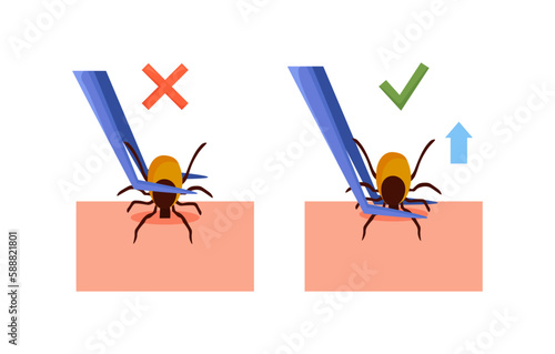 Removing encephalitis ticks after bite. How to remove mite. Parasite carrying disease. Tick grabbed into skin, it is removed with tweezers. First aid. Prevention of infections transmitted by mites