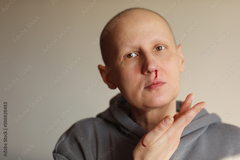 Young bald cancer sick woman is bleeding from her nose, effects of