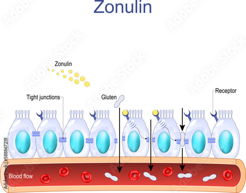 intestinal cells with Zonulin receptors, normal and Faulty tight