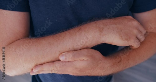Close up of man hairy arm skin with hyperpigmentation photo