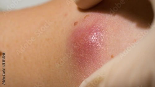 Inflamed atheroma examination, sebaceous cyst, skin closeup macro, fat cell accumulation in the inner layer of skin