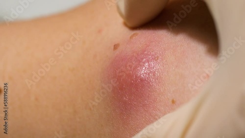 Dermatologist examines an inflamed cyst on patient's body, skin closeup macro (atheroma, sebaceous cyst)  photo