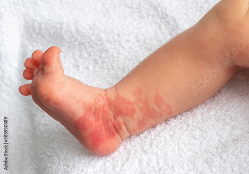 Fotografie Hemangioma red birthmark on the leg of newborn baby