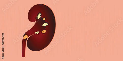 a kidney model with stones in it. kidney treatment banner, poster vector illustration.