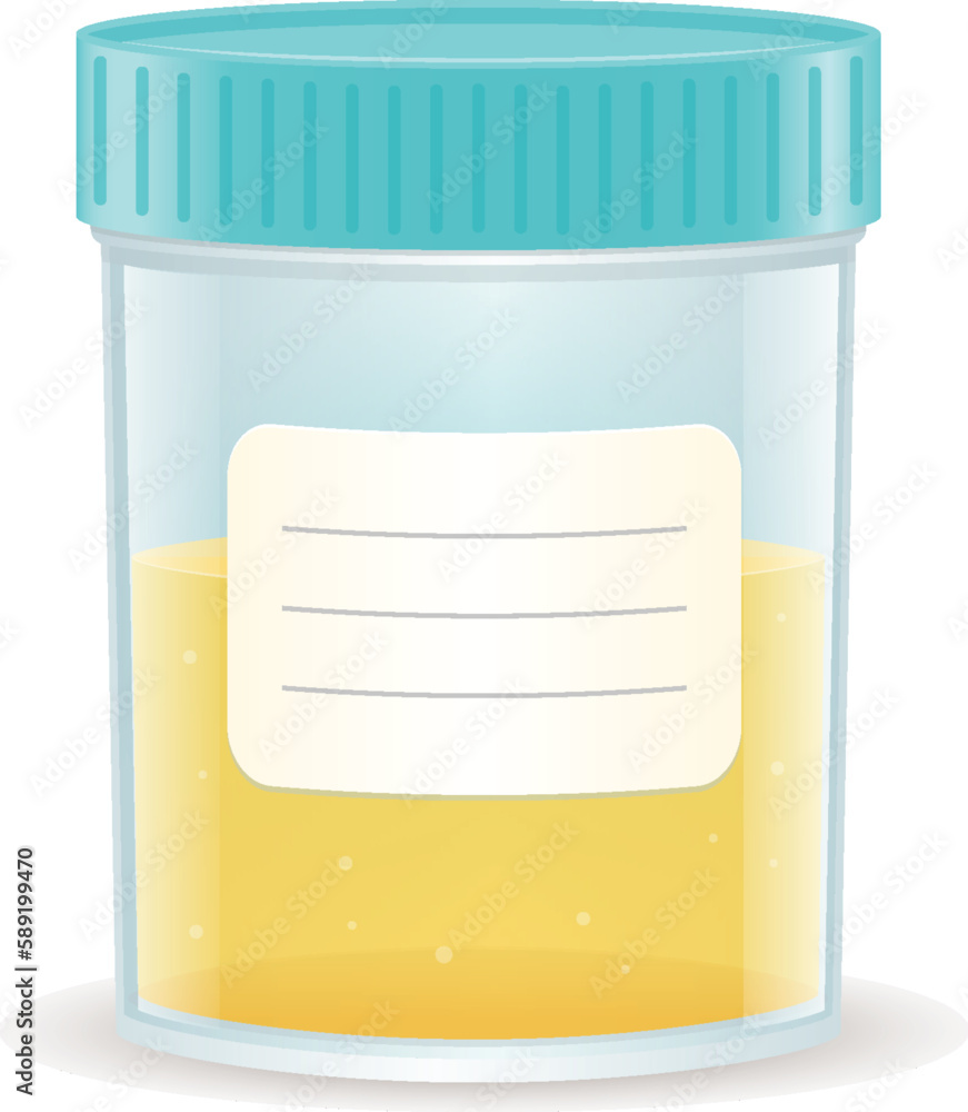 Specimen cup with urine realistic vector illustration isolated on white - obrazy, fototapety, plakaty 