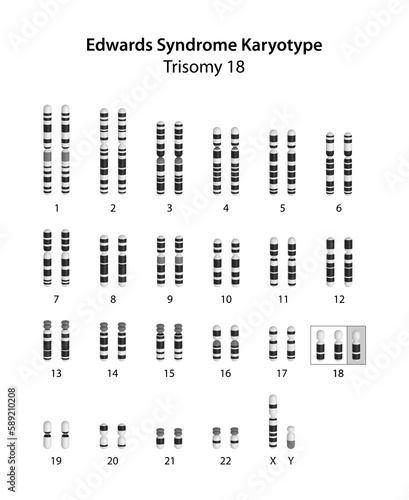 Edwards syndrome (trisomy 18) human (male) karyotype