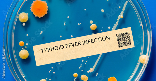 Photos Typhoid fever - Bacterial infection that causes fever, abdominal pain, and diarrhea
