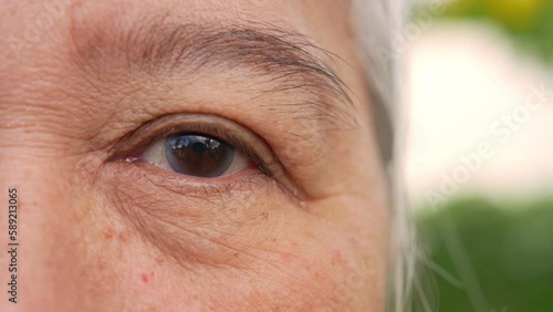 Close up of the senile cataract during eye examination. A white cloudy disc is seen in black eye circle, mature cataract, nuclear sclerosis cataract. Close up half face view
