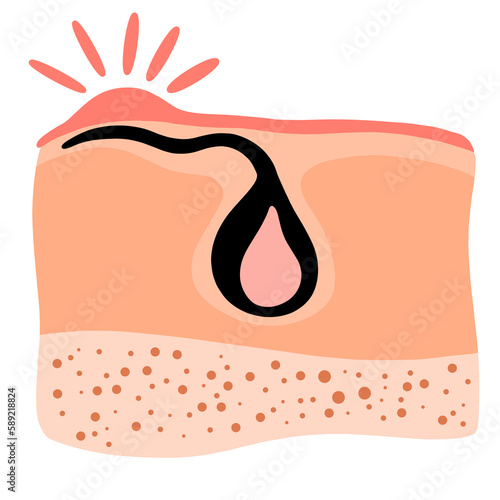Ingrown hair. Inflammation, skin problems. Anatomy infographics of hair. Flat illustration isolated on the white background.