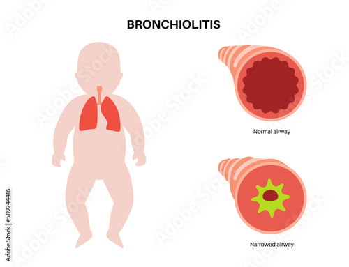 Bronchiolitis lung disease