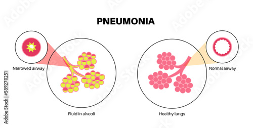 Pneumonia infection poster