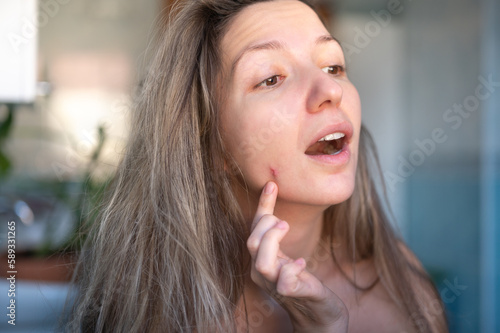 Young woman shows a finger on the red acne on her face. Portrait of a worried woman examining her face. Skin problems