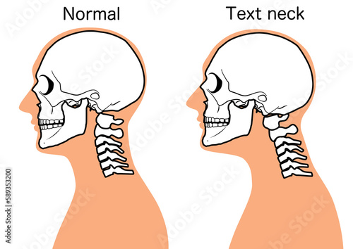 Photos Text neck