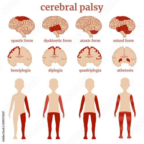 A diagram indicating the types of cerebral palsy using the example of drawings of the brain and a human figure. Conceptual medical poster. Vector illustration