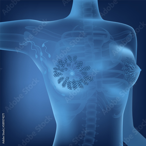Transparent, neon female torso on a blue background with mammary glands. Conceptual medical poster. Vector illustration