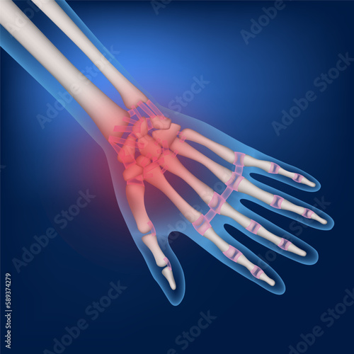 Bones of a human hand on a blue background. Inflammation of the joints. Medical poster. Vector illustration