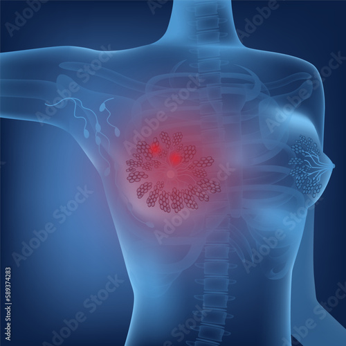 mammary cancer. Rendering of a female body. Medical poster. Vector illustration