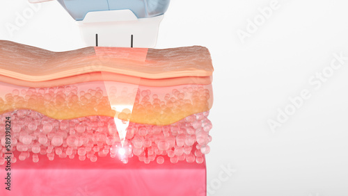 HIFU or Ultherapy laser treatment shot to SMAS layer to stimulate collagen. saggy skin treatment and anti aging concept. 3D rendering.
