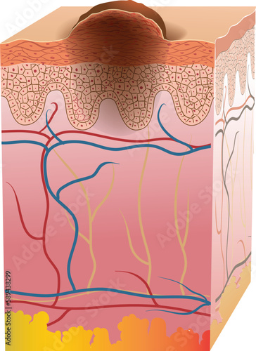 skin cancer cross section illustration