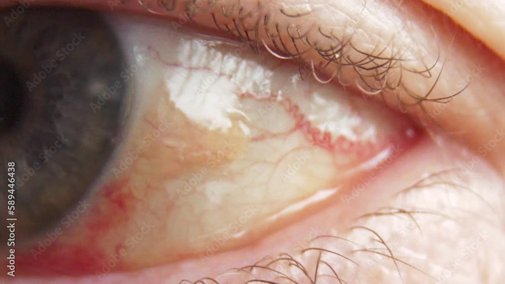 Ophthalmology. An eye with dilated blood vessels. Eye pressure