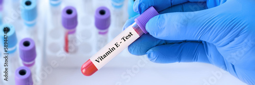 Doctor holding a test blood sample tube with Vitamin E test on the background of medical test tubes with analyzes.Banner.