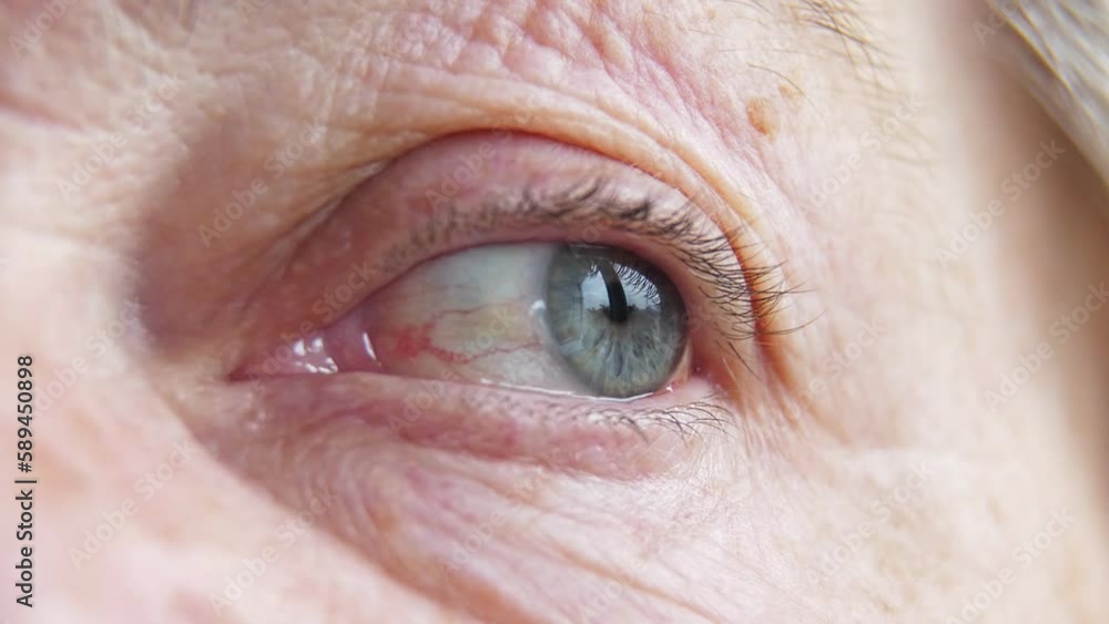 Video Stock Ophthalmology. Sick Eye with dilated blood vessels of an