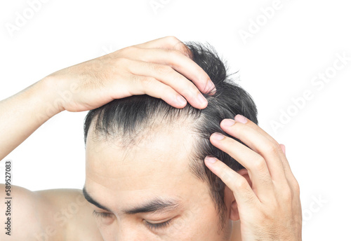 Closeup Young man serious hair loss problem with white backgroun for health care medical and shampoo product concept
