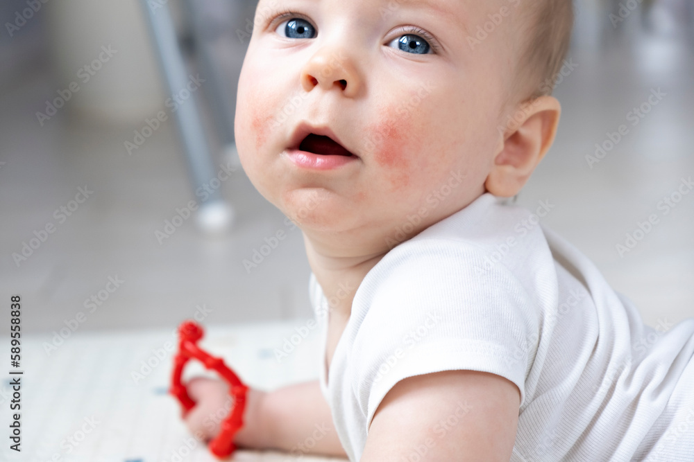 Baby face with rash spots on cheeks. Atopic dermatitis. Eczema. Allergy