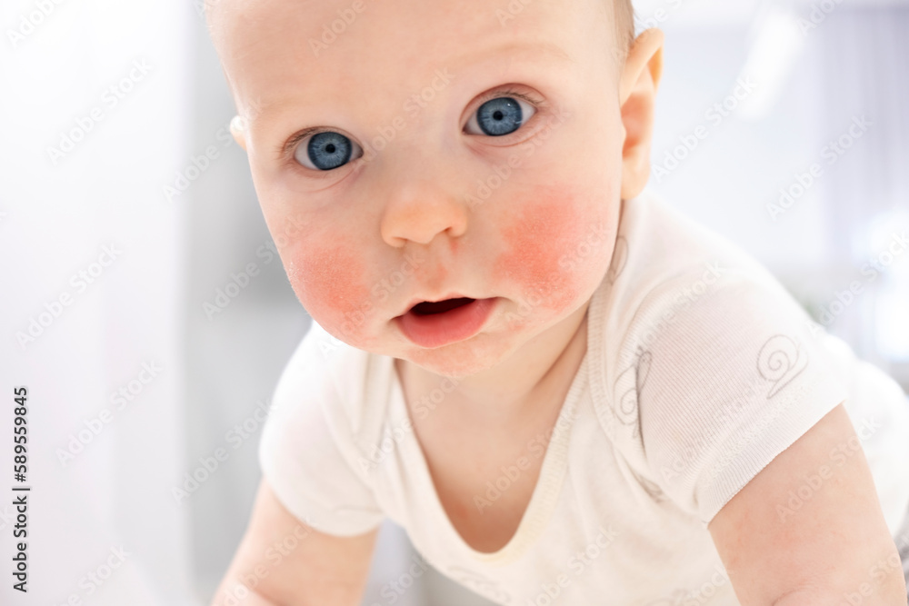 Baby face with eczema on cheeks. Atopic dermatitis. Dry skin, rash, itch and other dermatology problems. Baby skin care, diagnosis, medical treatment and therapy. Allergic reaction.