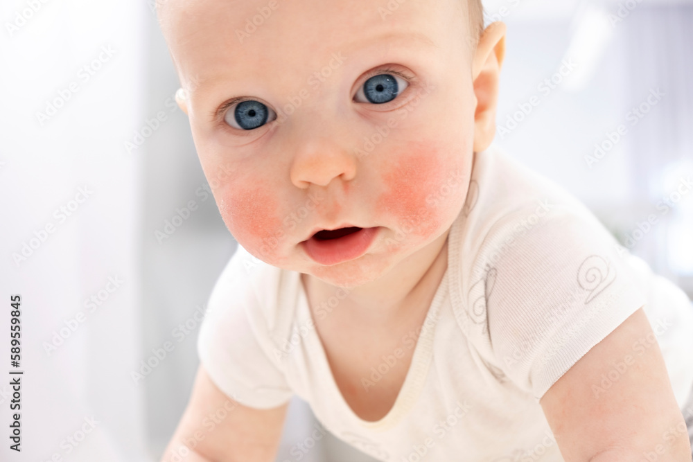 Baby face with eczema on cheeks. Atopic dermatitis. Dry skin, rash, itch and other dermatology problems. Baby skin care, diagnosis, medical treatment and therapy. Allergic reaction. Baby face with eczema on cheeks. Atopic dermatitis. Dry skin, rash, itch and other dermatology problems. Baby skin care, diagnosis, medical treatment and therapy. Allergic reaction.