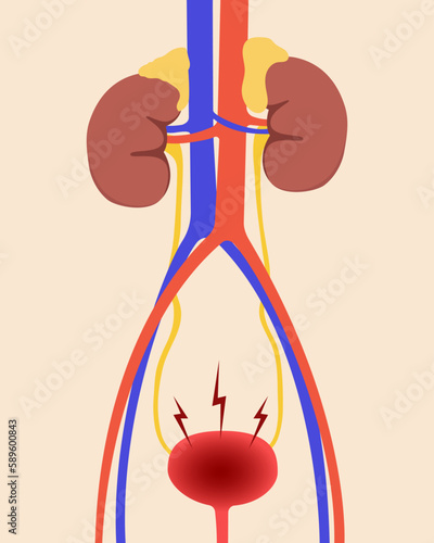 Inflamed bladder in the urinary system. Flat style. 