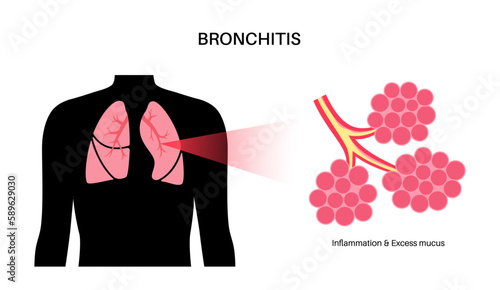Bronchitis lung disease